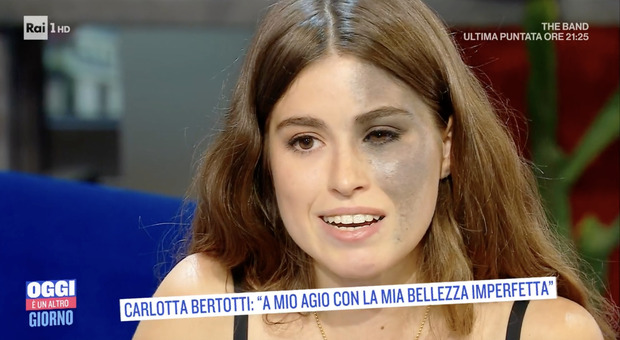 Oggi è un altro giorno, Carlotta Bertotti racconta la malattia: «Lentiggini blu in una sfera dell’occhio»