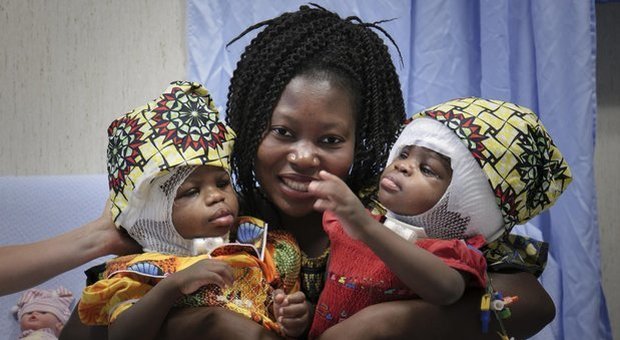 Roma, Il miracolo delle siamesi separate al Bambino Gesù: in trenta per far rinascere le gemelle Roma, Il miracolo delle siamesi separate al Bambino Gesù: in trenta per far rinascere le gemelle