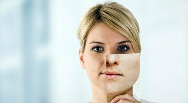 Acne e da mascherina, cause e come combatterla: le 5 regole dell'esperto