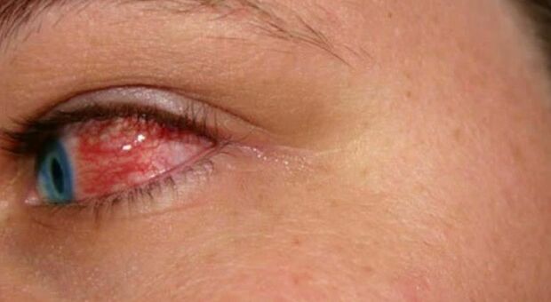 Febbre emorragica degli occhi, un paziente ricoverato in Europa: «Virus mortale in un caso su tre»