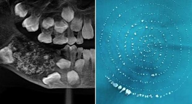 I dentisti estraggono 526 denti dalla bocca di un bimbo di 7 anni: caso rarissimo