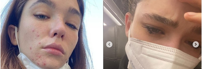 Matilde De Angelis, l'ansia, la sofferenza e l'acne. L'ho sfogo su Instagram: «Imparate a chiedere aiuto»