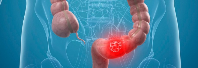 Tumore al colon, consumo elevato di antibiotici «aumenta il rischio del 49%»