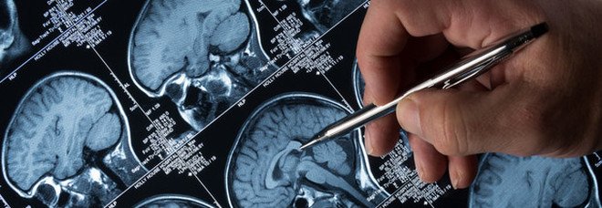Epilessia, sì in Ue al primo farmaco a base di cannabis indicato per forme rare Epilessia, sì in Ue al primo farmaco a base di cannabis indicato per forme rare