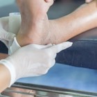 "Dita dei piedi da Covid": le lesioni che compaiono anche nei negativi a test e tamponi